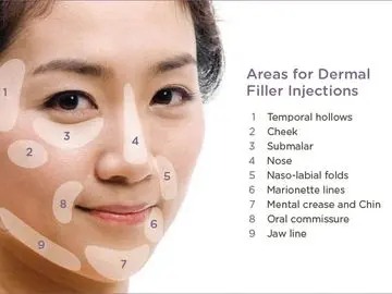 Dermal Filler Woman