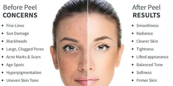 Chemical Peel Before & After