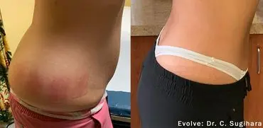 Woman waist before and after trim