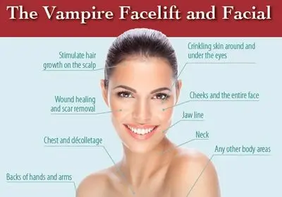 Vampire Facial