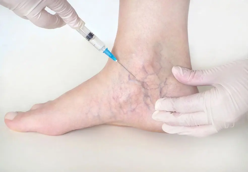 Foot Vein Treatment