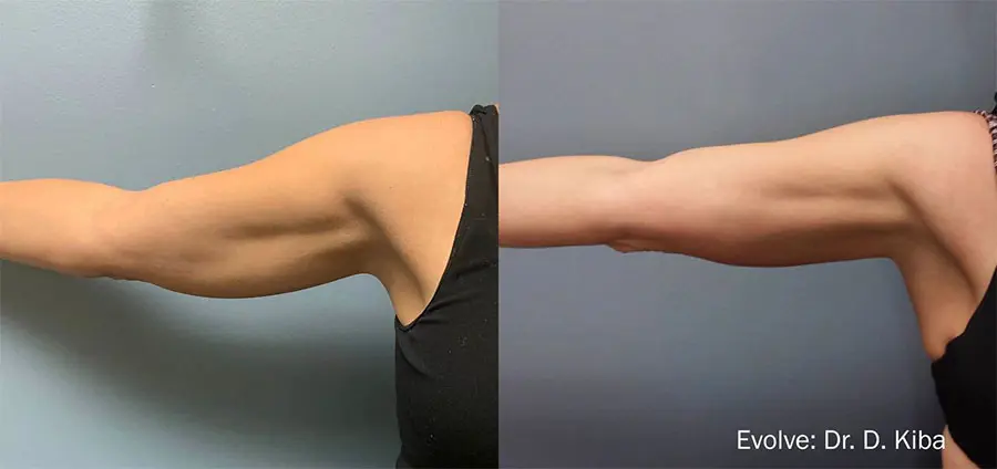 Arm before and after tite